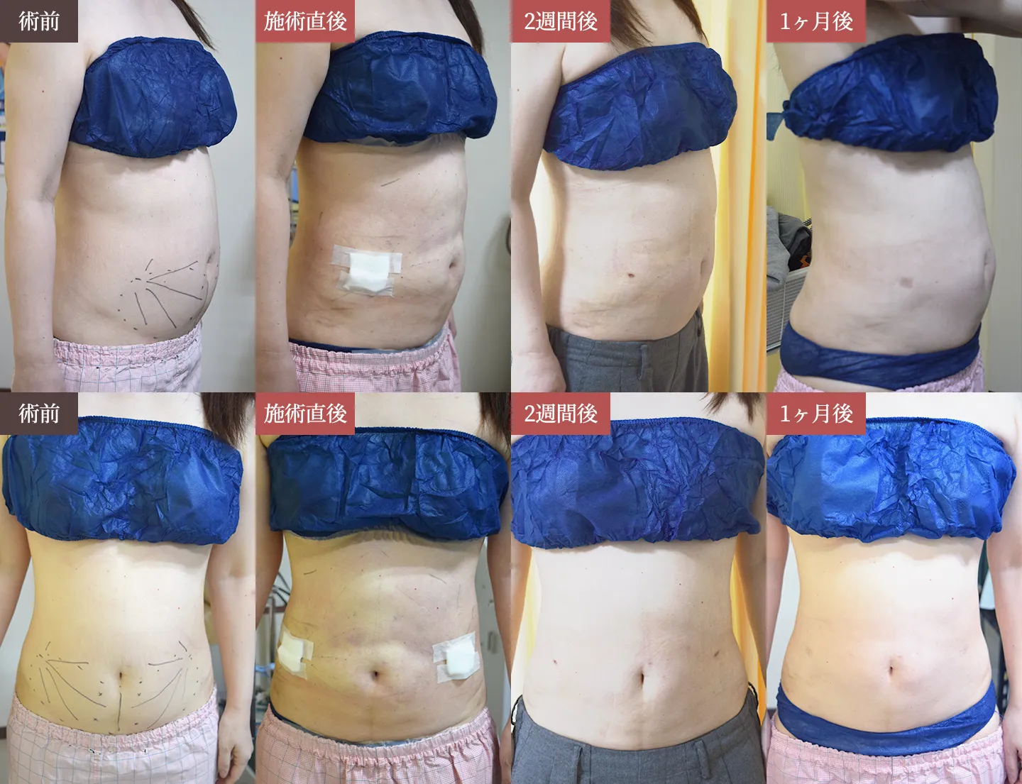 脂肪吸引の症例写真