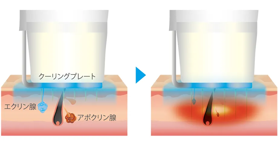 クーリングプレート エクリン腺 アポクリン腺